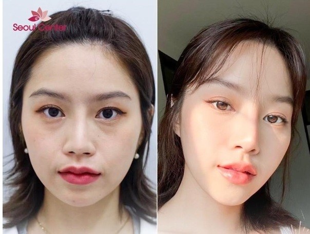 Giải đáp băn khoăn đối với phẫu thuật nâng mũi S Line