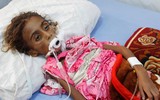 Xót xa khi chứng kiến hình ảnh trẻ đói ăn suy dinh dưỡng ở Yemen