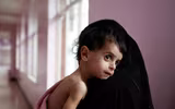 Xót xa khi chứng kiến hình ảnh trẻ đói ăn suy dinh dưỡng ở Yemen