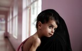 Xót xa khi chứng kiến hình ảnh trẻ đói ăn suy dinh dưỡng ở Yemen