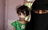 Xót xa khi chứng kiến hình ảnh trẻ đói ăn suy dinh dưỡng ở Yemen