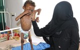 Xót xa khi chứng kiến hình ảnh trẻ đói ăn suy dinh dưỡng ở Yemen
