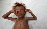 Xót xa khi chứng kiến hình ảnh trẻ đói ăn suy dinh dưỡng ở Yemen