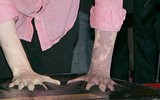 [ẢNH] 20 căn bệnh hiếm gặp nhất thế giới