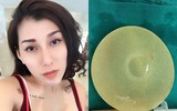 Biến chứng sau nâng ngực: Vỡ túi ngực, hoại tử... thậm chí mất mạng