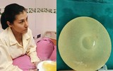 Biến chứng sau nâng ngực: Vỡ túi ngực, hoại tử... thậm chí mất mạng