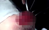 Biến chứng sau nâng ngực: Vỡ túi ngực, hoại tử... thậm chí mất mạng
