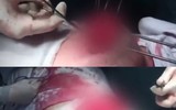 Biến chứng sau nâng ngực: Vỡ túi ngực, hoại tử... thậm chí mất mạng