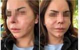 Biến chứng sau nâng ngực: Vỡ túi ngực, hoại tử... thậm chí mất mạng