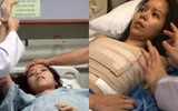 Biến chứng sau nâng ngực: Vỡ túi ngực, hoại tử... thậm chí mất mạng