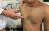 Nhận biết sớm những dấu hiệu viêm phổi để cả nhà 