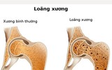 [ẢNH] Khiếp sợ bệnh nặng dễ mắc do Tết uống rượu 