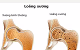 [ẢNH] Khiếp sợ bệnh nặng dễ mắc do Tết uống rượu 
