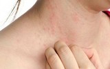 Thời tiết nồm ẩm cần đề phòng những bệnh gì?