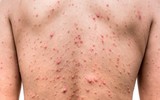 Thời tiết nồm ẩm cần đề phòng những bệnh gì?