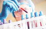 Quy trình xử lý chống phơi nhiễm HIV