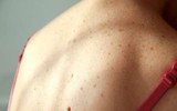 7 tác hại đáng sợ của tia UV đối với cơ thể