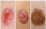 7 tác hại đáng sợ của tia UV đối với cơ thể