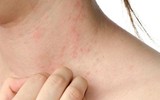 [ẢNH] Ăn dứa mùa hè (1): Cẩn trọng bởi lợi có mà hại cũng nhiều