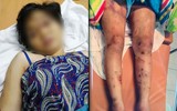 Toàn bộ vụ việc thai phụ 18 tuổi bị tra tấn dã man đến sảy thai ở TP.HCM