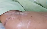 Toàn bộ vụ việc thai phụ 18 tuổi bị tra tấn dã man đến sảy thai ở TP.HCM