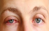 10 loại dịch bệnh xảy ra vào mùa hè và cách phòng chống