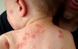 10 bệnh dễ lây nhiễm từ bể bơi và cách phòng tránh