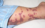 10 bệnh dễ lây nhiễm từ bể bơi và cách phòng tránh