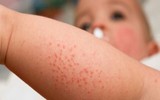 [ẢNH] Sốt xuất huyết vào mùa: Những điều kiêng kỵ khi chữa trị