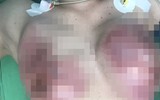 Hoại tử kinh hoàng trên cơ thể vì tiêm mỡ tự thân, chất làm đầy