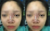 Hoại tử kinh hoàng trên cơ thể vì tiêm mỡ tự thân, chất làm đầy