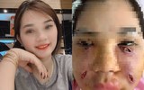 Hoại tử kinh hoàng trên cơ thể vì tiêm mỡ tự thân, chất làm đầy