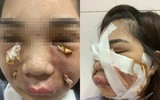 Hoại tử kinh hoàng trên cơ thể vì tiêm mỡ tự thân, chất làm đầy