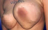 Hoại tử kinh hoàng trên cơ thể vì tiêm mỡ tự thân, chất làm đầy