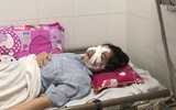 Hoại tử kinh hoàng trên cơ thể vì tiêm mỡ tự thân, chất làm đầy