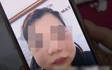 Hoại tử kinh hoàng trên cơ thể vì tiêm mỡ tự thân, chất làm đầy