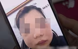 Hoại tử kinh hoàng trên cơ thể vì tiêm mỡ tự thân, chất làm đầy