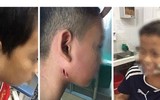 [ẢNH] Những điều cần biết về Whitmore- Bệnh truyền nhiễm có nguy cơ gây tử vong