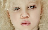 [ẢNH] Ngỡ ngàng trước vẻ đẹp khác biệt của những người mẫu bạch tạng nổi tiếng thế giới