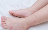 [ẢNH] Hạ sốt an toàn cho trẻ bằng các mẹo dân gian