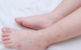 [ẢNH] Hạ sốt an toàn cho trẻ bằng các mẹo dân gian