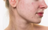 [ẢNH] Tác hại khôn lường của việc sử dụng mỹ phẩm kém chất lượng