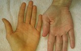 [ẢNH] Những dấu hiệu bất thường trên cơ thể cảnh báo ung thư sớm