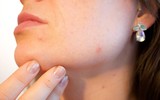[ẢNH] Cảnh báo những căn bệnh dễ mắc phải khi trời nồm ẩm và cách phòng tránh