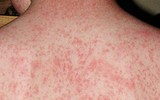 [ẢNH] Cảnh báo những căn bệnh dễ mắc phải khi trời nồm ẩm và cách phòng tránh