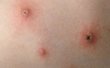 [ẢNH] Cảnh báo những căn bệnh dễ mắc phải khi trời nồm ẩm và cách phòng tránh