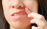 [ẢNH] Những giải pháp tự nhiên giúp điều trị nhiệt miệng cực hiệu quả