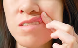 [ẢNH] Những giải pháp tự nhiên giúp điều trị nhiệt miệng cực hiệu quả
