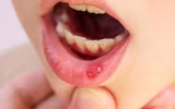[ẢNH] Những giải pháp tự nhiên giúp điều trị nhiệt miệng cực hiệu quả