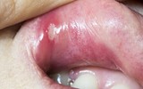 [ẢNH] Những giải pháp tự nhiên giúp điều trị nhiệt miệng cực hiệu quả